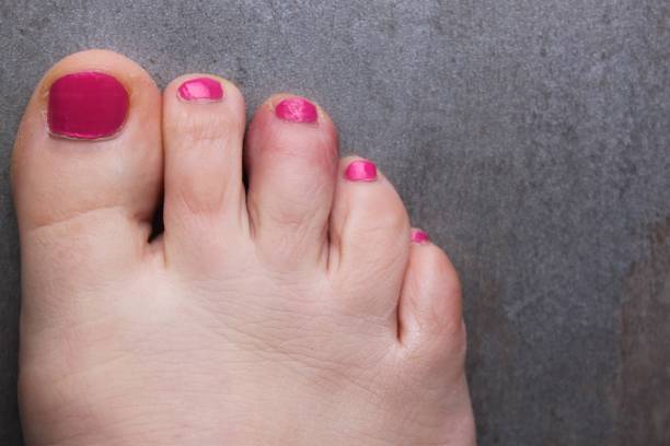 Damaged Toenail Broken Nail With Copy Space Stock Photos, Pictures &  Royalty-Free Images - iStock