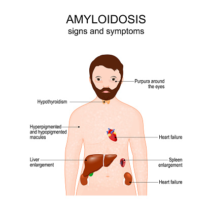 Amyloidosis. Signs and symptoms. Human body with Purpura around the eyes, skin rash, liver, kidneys, thyroid gland, heart and spleen. Vector poster