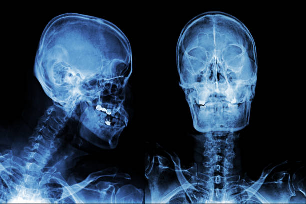 X-ray of normal human skull AP.
