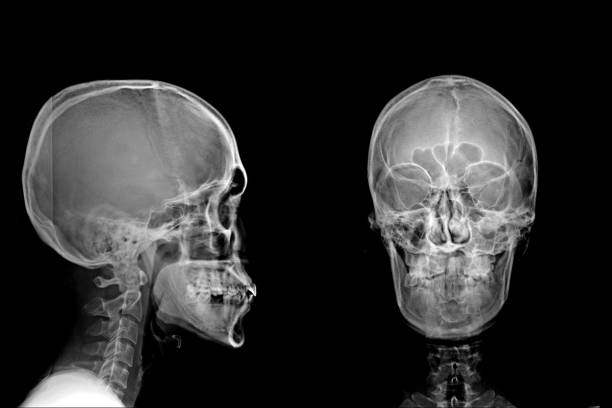 istock X-ray of normal human skull AP. 1461318551