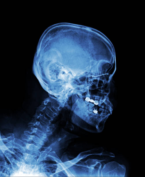 istock X-ray of normal human skull AP. 1461318761