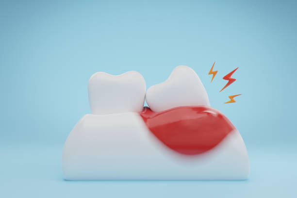 gums and teeth disease Gums and teeth disease wisdom tooth infection on blue background. 3D rendering. wisdom-teeth stock pictures, royalty-free photos & images