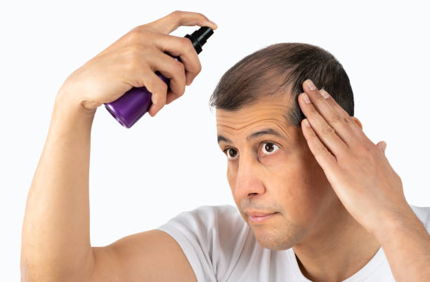 istock man applying with spray a hair loss treatment 1461373169