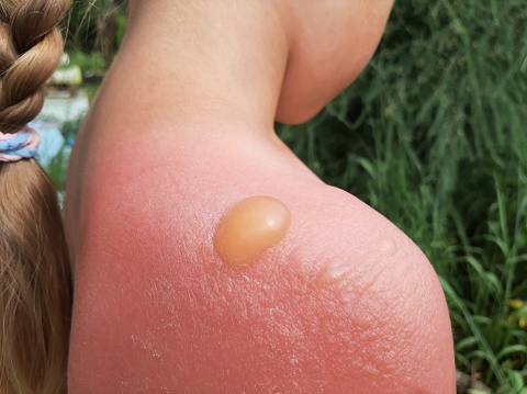 Sunburn on the skin of a child. The sun's burn turned into blisters. Shoulders of a 5-year-old girl with a sunburn. What will happen if the child bathes at lunch under the sun