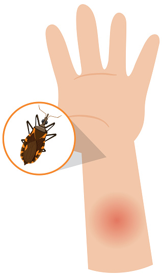 Human arm swollen from kissing bug bite illustration