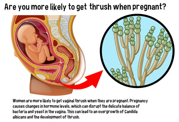 Vaginal thrush during pregnancy infographic with explanation Vaginal thrush during pregnancy infographic with explanation illustration genital herpes stock illustrations