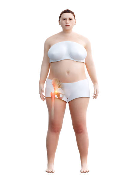 Obese woman with femur joint pain caused by cartilage wear and tear, isolated on white background Obese woman with femur joint pain caused by cartilage wear and tear, isolated on white background. 3D illustration obese joint pain stock pictures, royalty-free photos & images