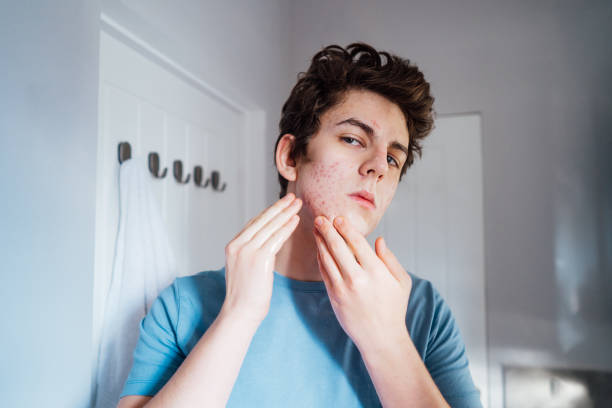 adolescente caucasiano concentrado com problema de acne em seu rosto olhando no espelho no banheiro de casa. adolescente cuidados com a pele todos os dias processo de tratamento. - human skin sparse washing face human face - fotografias e filmes do acervo