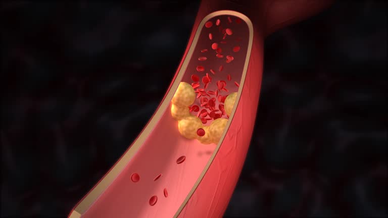 Cholesterol clogging artery