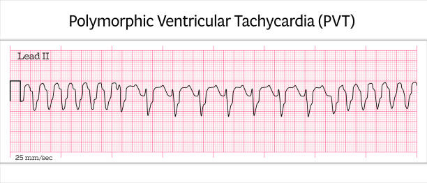 Polymorphic Ventricular Tachycardia (PVT) ECG – Polymorphic VT - 8 Second ECG Paper Polymorphic Ventricular Tachycardia (PVT) ECG – Polymorphic VT - 8 Second Electrocardiography Paper - Vector Medical Illustration heart ventricle stock illustrations