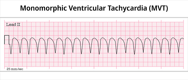 Polymorphic Ventricular Tachycardia (PVT) ECG – Polymorphic VT - 8 Second Electrocardiography Paper - Vector Medical Illustration