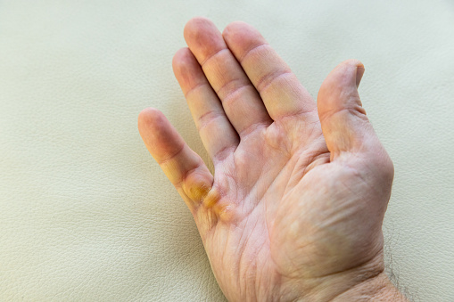 Dupuytren's contracture on right hand little finger of 53 year old man's palm. Area was also treated with radio therapy 3 years ago. Model released.