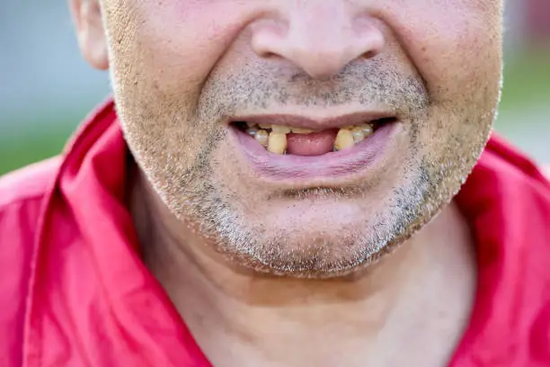 Toothless man in his 60s with stubble on his cheeks and chin, close-up of lower part of his face.