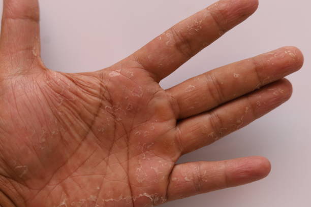 blistering hands, palm skin peeling off allergic reactions in the body.  psoriasis, dermatitis, skin.  isolated on white background. - wound blood human finger human hand imagens e fotografias de stock