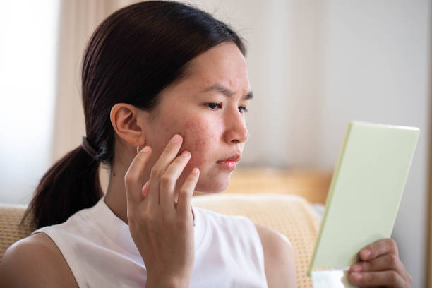 Conceptual shot of Acne & Problem Skin on female face. Portrait of Asian woman worry about her face when she saw the problem of acne inflammation and scar by the mini mirror. acne stock pictures, royalty-free photos & images