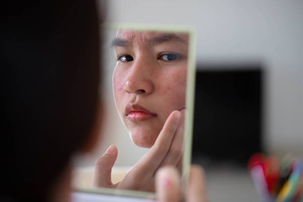 istock Conceptual shot of Acne & Problem Skin on female face. 1462797596