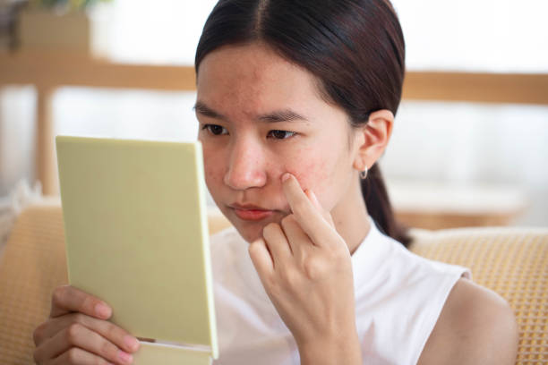 istock Conceptual shot of Acne & Problem Skin on female face. 1462797601