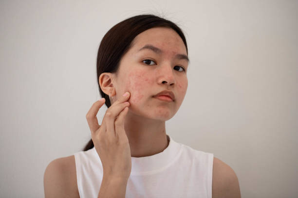 woman with acne Cropped shot of a young woman squeezing a pimple on her face pimple stock pictures, royalty-free photos & images