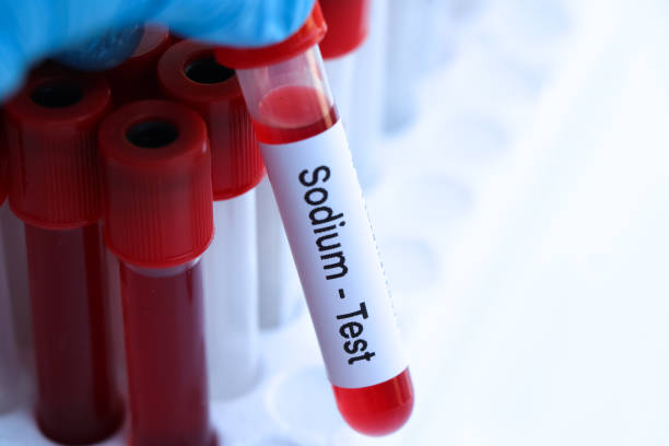 istock Sodium test to look for abnormalities from blood 1462842593