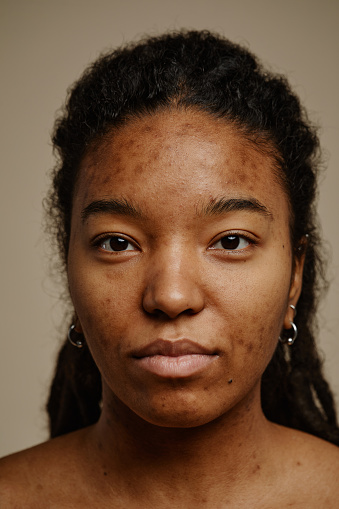 Vertical close up portrait of ethnic young woman looking at camera, focus on real skin texture and acne scars on face