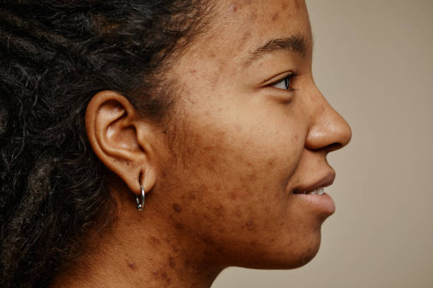 Profile ethnic young woman smiling with acne scars on face and ear piercings Minimal profile portrait of ethnic young woman smiling with acne scars on face and ear piercings scar stock pictures, royalty-free photos & images