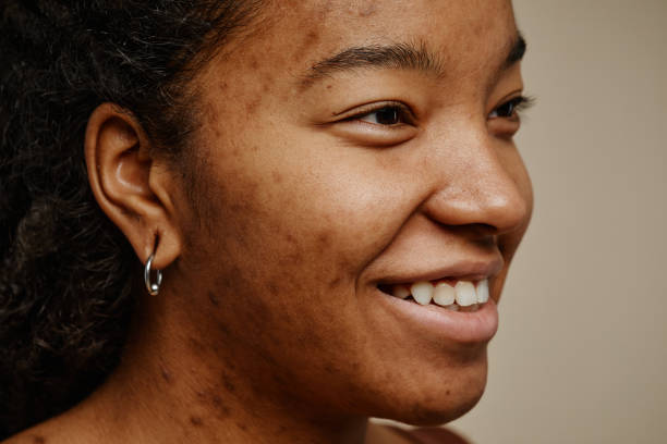 istock Close up ethnic young woman with acne scars on face smiling 1463321927