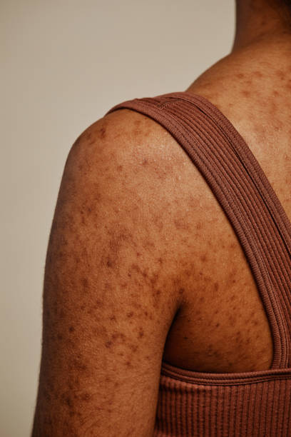 foto de detalhe da textura da pele do corpo feminino e cicatrizes de acne nas costas e ombros - tattoo women back rear view - fotografias e filmes do acervo