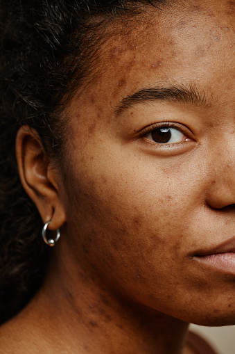 Vertical macro shot of acne scars on face of young black woman looking at camera