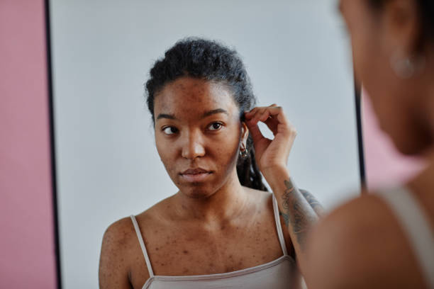 istock Young black woman with acne scars looking in mirror insecure in appearance 1463321955