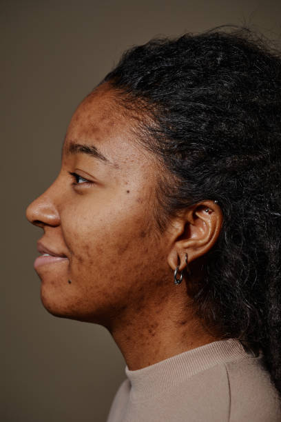 istock Close up profile smiling black woman with acne scars on face 1463321958