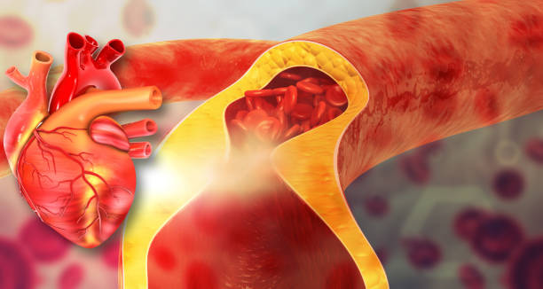 istock Cholesterol blocked arteries with human heart 1463357856