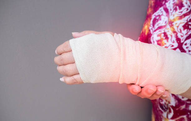 gebrochener arm konzept. gegoss gebrochener arm zur immobilisierung nach arm- und handverletzungen. - pain joint human hand arthritis stock-fotos und bilder