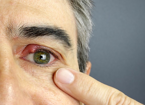 Close-up of a man eye stye. Ophthalmic hordeolum disease, chalazion
