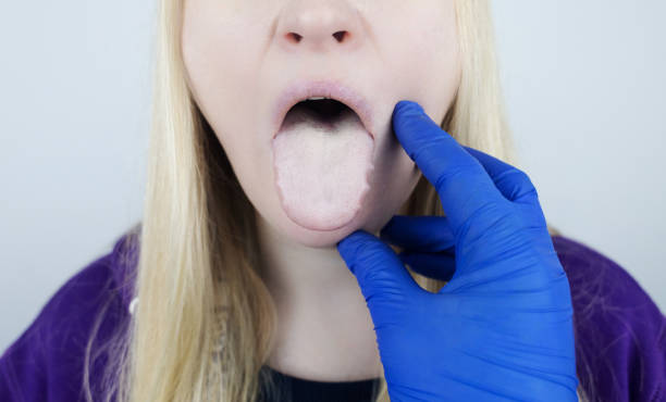 kobieta ma biały język. bolesna biała powłoka na błonie śluzowej języka. choroby przewodu żołądkowo-jelitowego, wątroby i pęcherzyka żółciowego. konsekwencje przyjmowania antybiotyków. - candida zdjęcia i obrazy z banku zdjęć