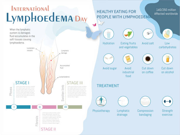 Infographic Lymphedema Infographic Lymphedema, stage, treatments and recommended diet with corresponding icons on blue and white background. obese joint pain stock illustrations