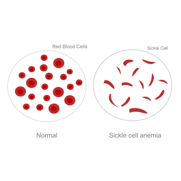 ilustraciones, imágenes clip art, dibujos animados e iconos de stock de la morfología diferenciada de los glóbulos rojos entre las células normales y las células falciformes en el trastorno de anemia de células falciformes. - sickle cell anemia red blood cell blood cell anemia