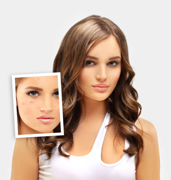 istock Post-Acne Marks /Treating Acne Scars.Acne Scar Removal 1463578574