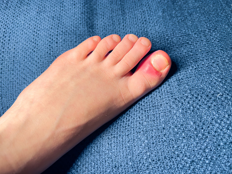 Ingrown Nail Or Onychocryptosis Concept Foot Of Scandinavian Child With