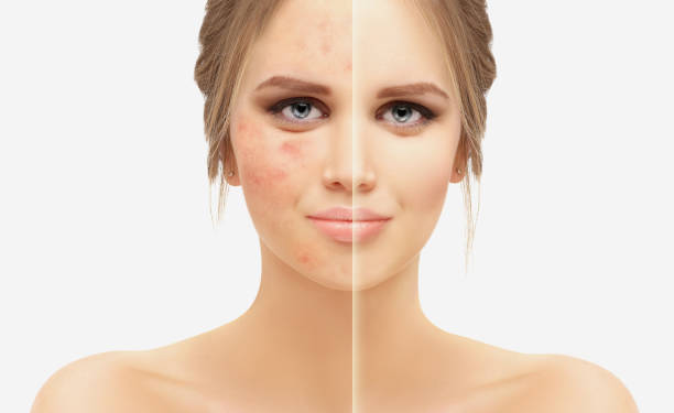 istock Post-Acne Marks /Treating Acne Scars.Acne Scar Removal 1463823576