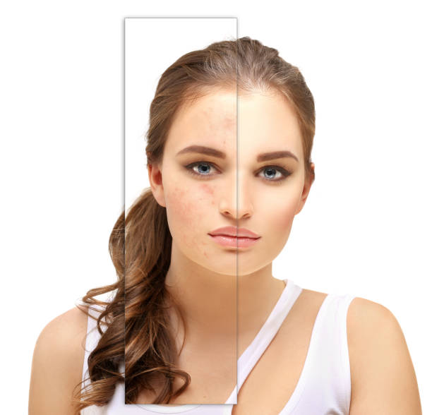 istock Post-Acne Marks .Treating Acne Scars.Acne Scar Removal 1463897136