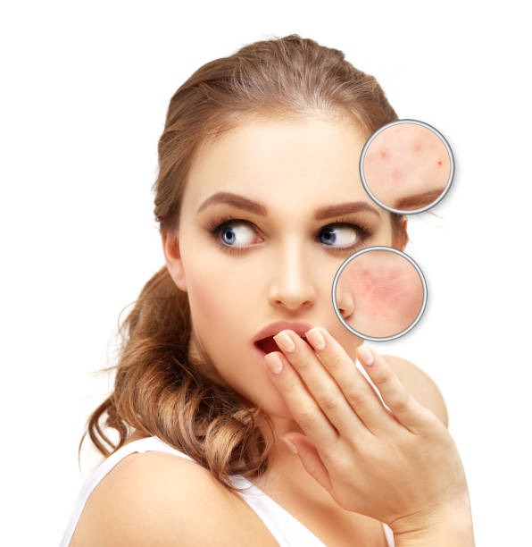 istock Post-Acne Marks .Treating Acne Scars.Acne Scar Removal 1463897152