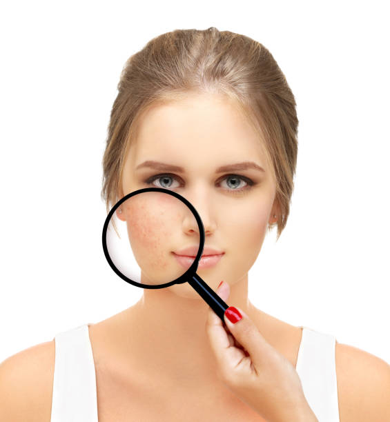 istock Post-Acne Marks .Treating Acne Scars.Acne Scar Removal 1463898018