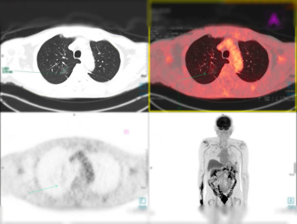 Positron emission tomography (PET) CT scan uses a radioactive drug (tracer) to show both normal and abnormal metabolic activity of Whole human body for detect cancer recurrence after surgery . la tomografía computarizada por emisión de positrones (tep) utiliza un fármaco radiactivo (marcador) para mostrar la actividad metabólica normal y anormal de todo el cuerpo humano para detectar la recurrencia del cáncer después de la cirugía.