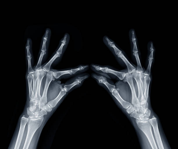 Film x-ray both hand oblique view show  human's hands isolated  on black background . stock photo