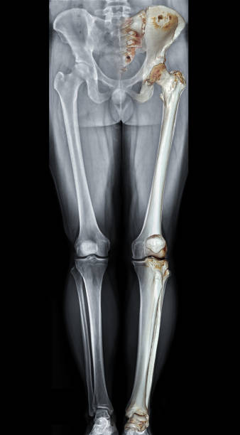 istock Scanogram is a Full-length standing AP radiograph of both lower extremities including the hip, knee, and ankle with 3D rendering. 1463945443