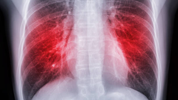 Chest x-ray image for screening diagnosis TB,tuberculosis and covid-19. stock photo