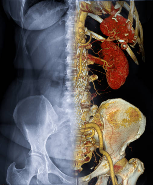 cta abdominal aorta 3d rendering fusion with x-ray abdomen image. - cat scan abdomen medical scan x ray fotografías e imágenes de stock