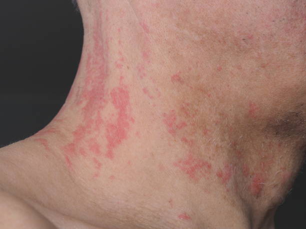 istock red spots allergy irritation on a man's neck 1463967858