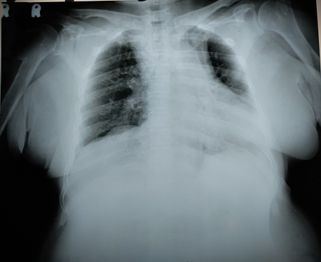 Pulmonary edema is a condition in which fluid accumulates in the air spaces of the lungs, making it difficult to breathe. This can be caused by heart problems such as heart failure, heart attack, or high blood pressure, as well as other conditions such as lung disease, kidney failure, or exposure to certain toxins. Symptoms of pulmonary edema can include shortness of breath, coughing, chest pain, and wheezing. In severe cases, pulmonary edema can lead to low oxygen levels in the blood and can be life-threatening.\n\nDiagnosis of pulmonary edema typically involves a physical examination, medical history, and tests such as a chest X-ray or an echocardiogram. Treatment depends on the underlying cause and can include medications to improve heart function, oxygen therapy, and in severe cases, removal of excess fluid through a tube inserted into the lungs. Lifestyle changes such as quitting smoking and reducing salt intake can also help manage the condition.\n\nIt is important to seek medical attention promptly if you experience symptoms of pulmonary edema, as early treatment can help prevent further complications.