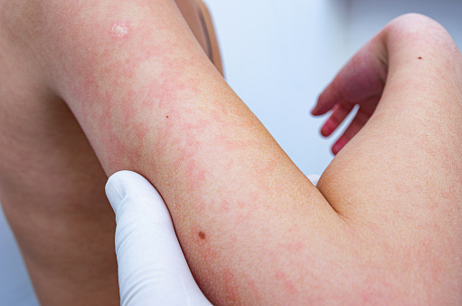 Hydrozole Cream